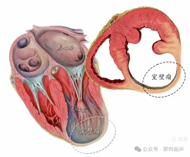 室壁瘤超声表现及鉴别